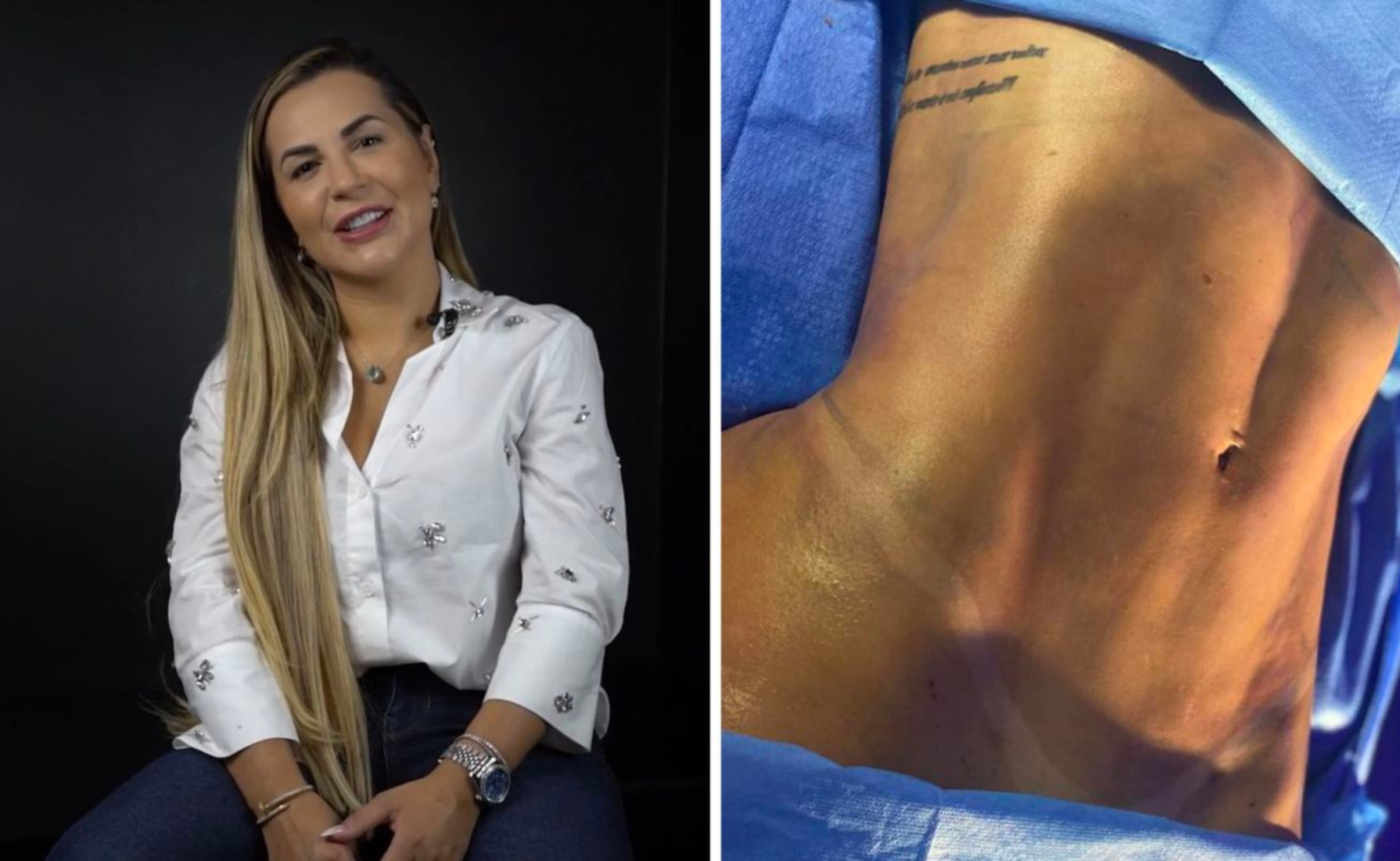 Antes e depois da Lipo LAD realizado pela Dra. Deolane Bezzerra na JK Estética