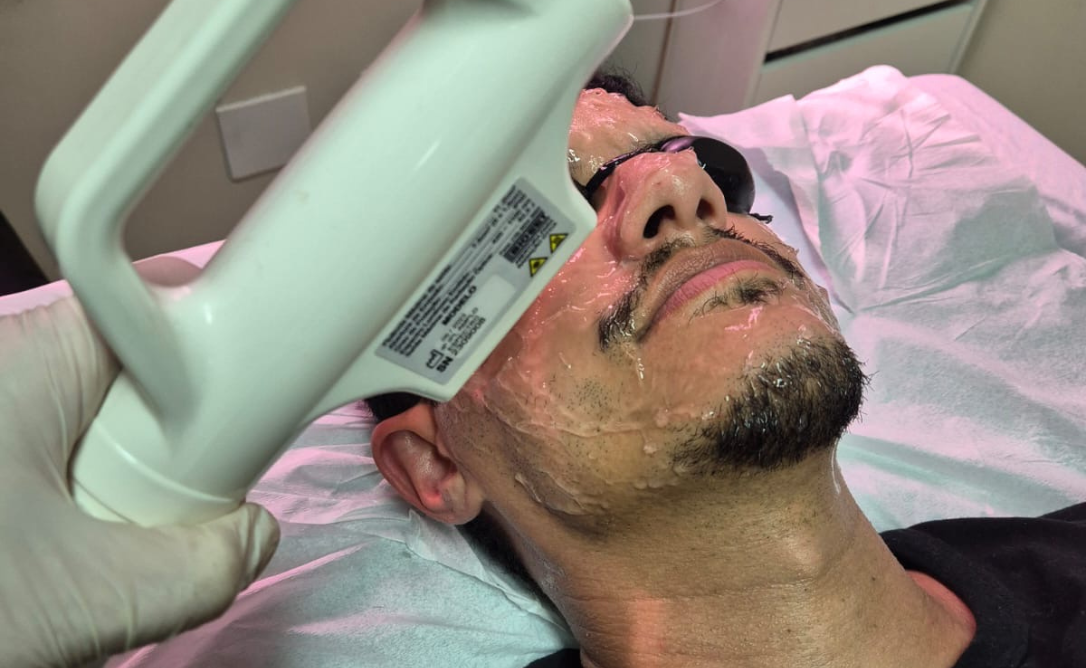 A revolução na estética: Limpeza de pele com máscara emoliente e luz pulsada facial com a Esteticista Lucilene Ramos