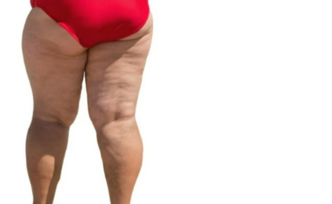 Lipoaspiração como tratamento para lipedema: Cirurgia pode melhorar qualidade de vida das pacientes