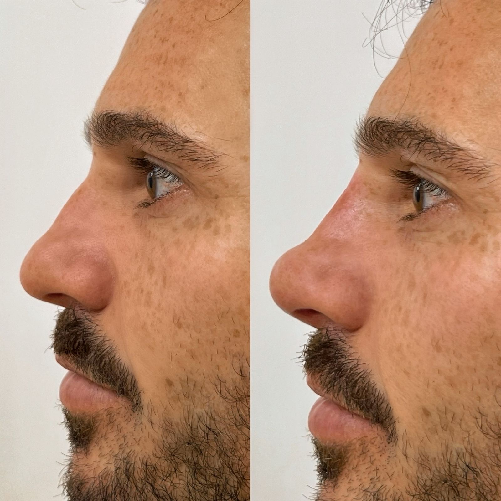 eac8c3ee-cf69-40c0-abc5-0d10af56f9d9 Ator Murilo Cunha realiza procedimento nasal em São Paulo: “Superou minhas expectativas”