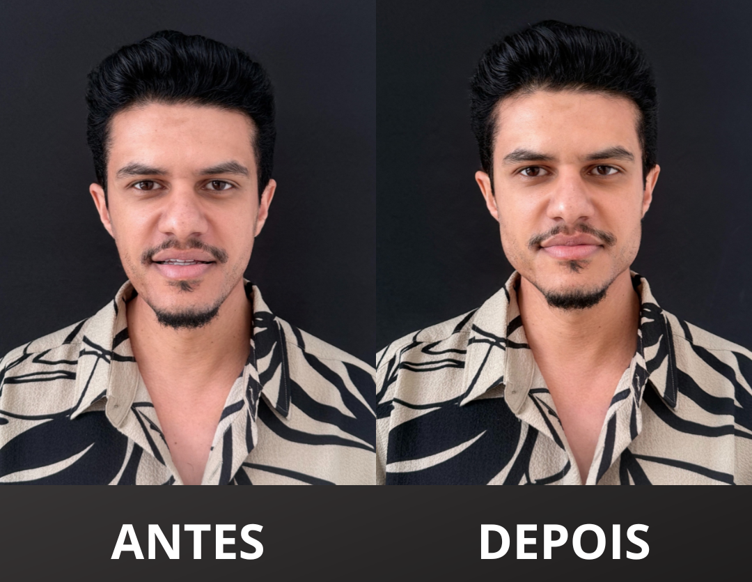 ANTES-e1776111044407 “Me sinto outra pessoa” diz Danilo Rasquinho depois de procedimento com a Dra. Mara Giffoni